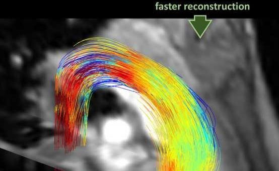 Künstliche Intelligenz beschleunigt MRI des Blutflusses