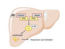 Eine weitere genetische Ursache für die nicht-alkoholische Fettleber entdeckt