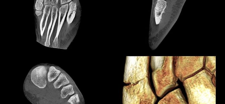 Perspektive DVT – Anwendung der DVT in der sportmedizinischen Extremitätendiagnostik