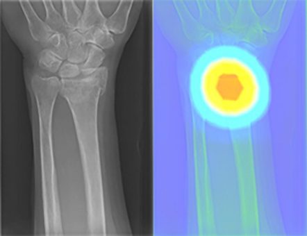 Künstliche Intelligenz lernt Knochenbrüche und Nierenschäden zu erkennen