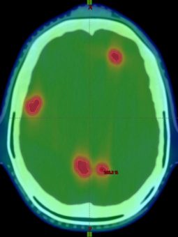 Simultanbestrahlung von Hirnmetastasen: Studie soll wichtige Grundlagen schaffen
