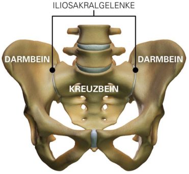 Achtung Verwechslungsgefahr – Ist es ein Bandscheibenvorfall oder das Iliosakralgelenk?