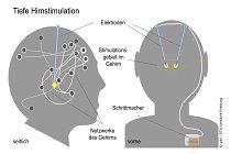 Tiefe Hirnstimulation bei Zwangsstörungen:  Ärzt*innen fordern besseren Zugang für Patient*innen