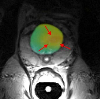 Schnelle MRT-Quantentechnologie für die Tumordiagnostik