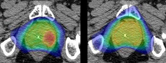 Internationale Freiburger Studie: Prostatakrebs gezielt bestrahlen