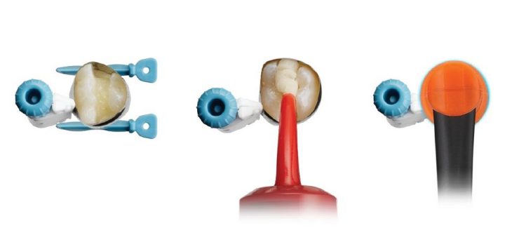 Dentsply Sirona: Langlebige Restaurationen, zahnfarben und ganz ohne Bonding – eine echte Alternative zu Kompositen in schwierigen Situationen