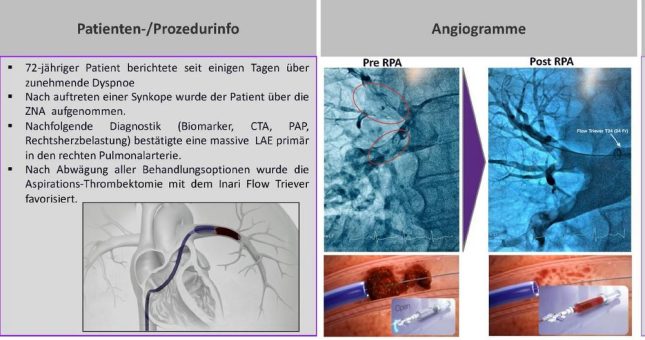 Neues Verfahren bei Lungenembolie