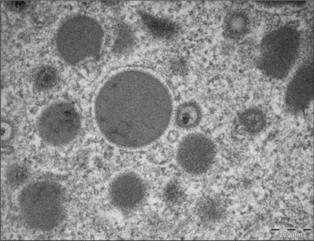 Forschungserfolg zu Cytomegalovirus-Infektion