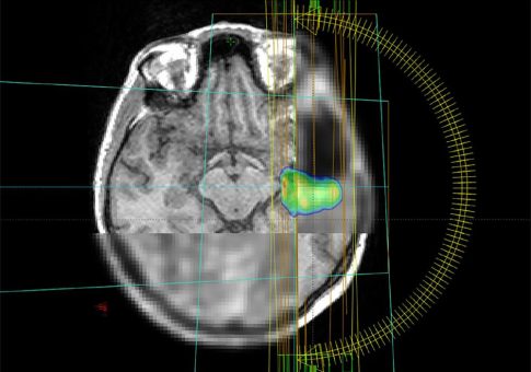 Aggressive Hirntumore dank innovativer Bildgebung und KI präzise bestrahlen