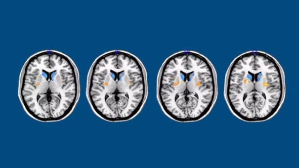 Neue Hoffnung für Parkinson-Patienten durch Stammzelltechnologie?