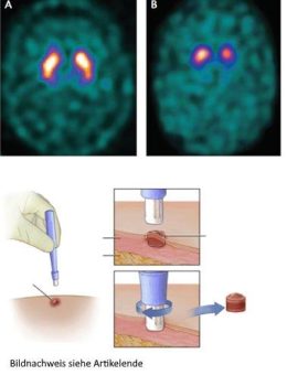 Die Diagnose von Parkinson: