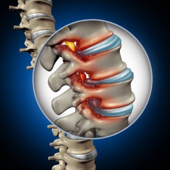 Spinalkanalstenose: Trotz OP leidet Musikproduzent Ralph Siegel weiter unter heftigen Schmerzen