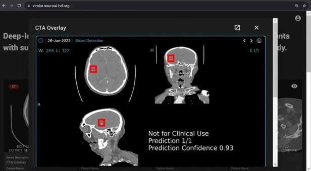 Schnellere und zuverlässigere Schlaganfalldiagnostik dank künstlicher Intelligenz