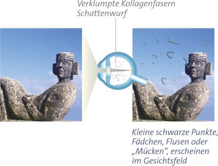 ebiga-VISION fördert die SETU-Floater-Interventionsstudie