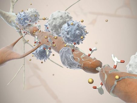 Multiple Sklerose (MS): Wenn sich das Immun­system gegen den eigenen Körper wendet