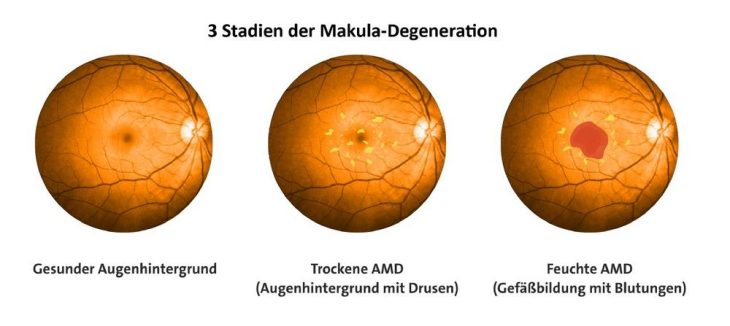 Makuladegeneration durch geographische Atrophie: AREDS-Studien quantifizieren Behandlungserfolg mit Mikronährstoffen!